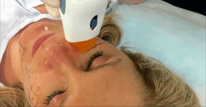 Patient undergoing thermage treatment