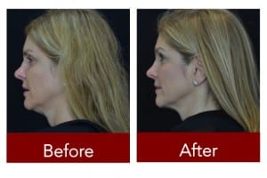 Kybella before and after photos