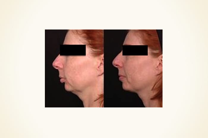 Before & After Radiofrequency