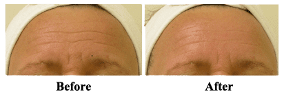 before and after