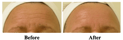 Hydrafacial before and after photos of forehead