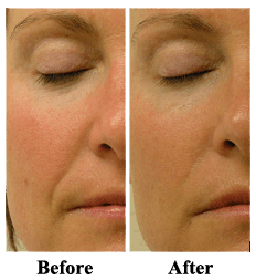 Hydrafacial before and after photos