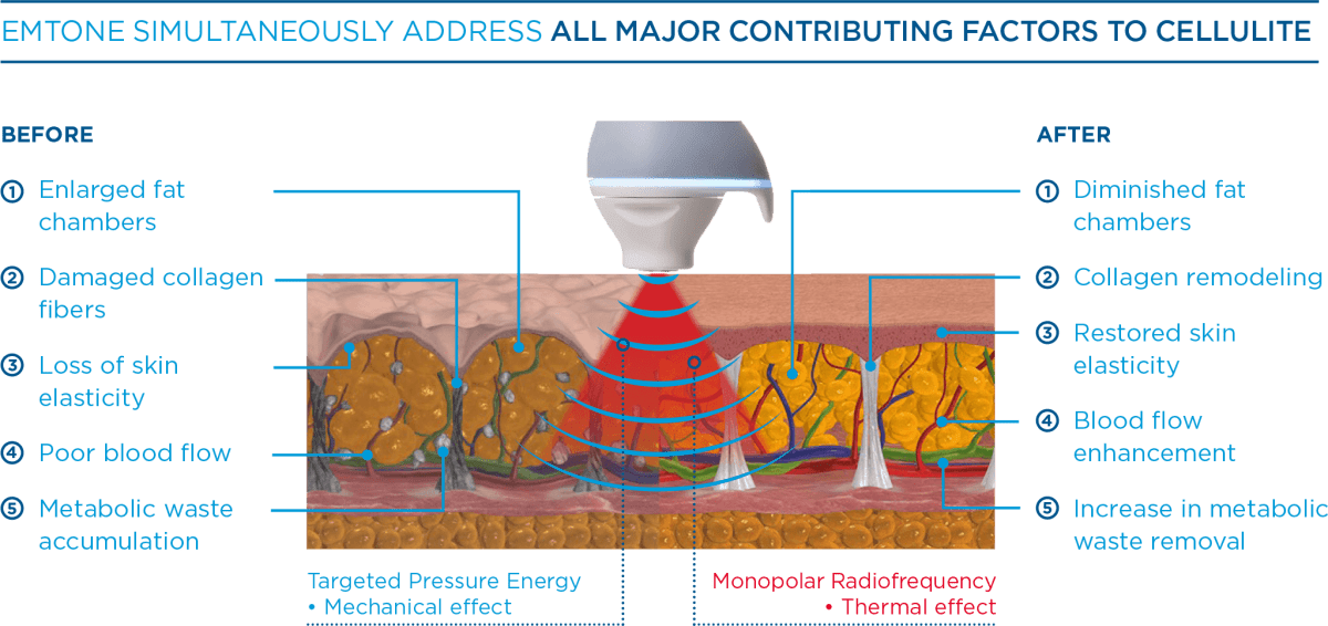 Emtone. Emtone btl. Btl exilis ultra 360. Emtone против целлюлита. Emtone.