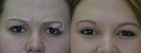 Close-up of woman's eyes and forehead before and after BOTOX treatment.