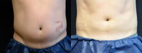 Pictures of man's midsection before and after a CoolSculpting treatment.