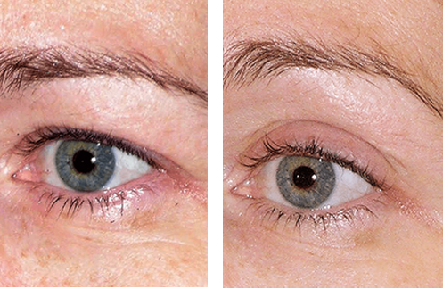 Image of eyes showing before and after results with thermage